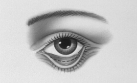 eyelid1